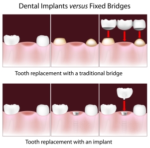 Implant vs bridge