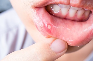 Aphthous Ulcer shutterstock low-res